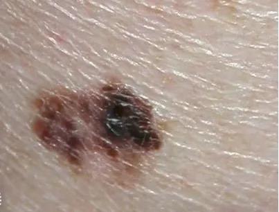 Melanom pigmentat