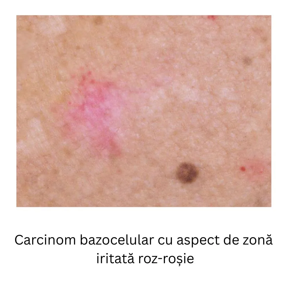 carcinom cu aspect de pata roz rosie 2 carcinom cu aspect de pata roz rosie 1