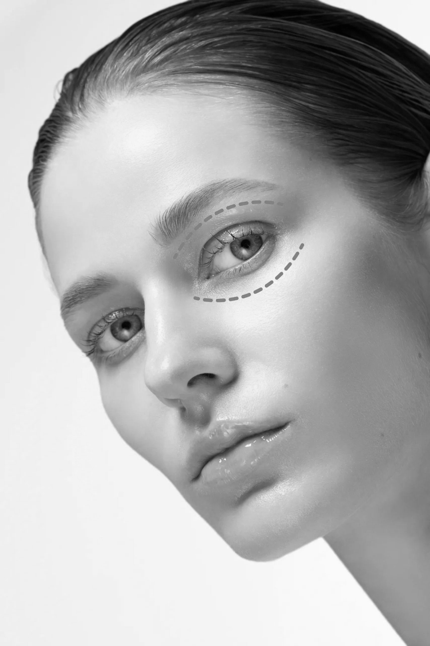 Blefaroplastia nechirurgicală cu laserul eCO2 fractionat