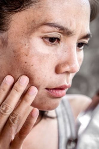 Cum apare melasma? 11 cum apare melasma