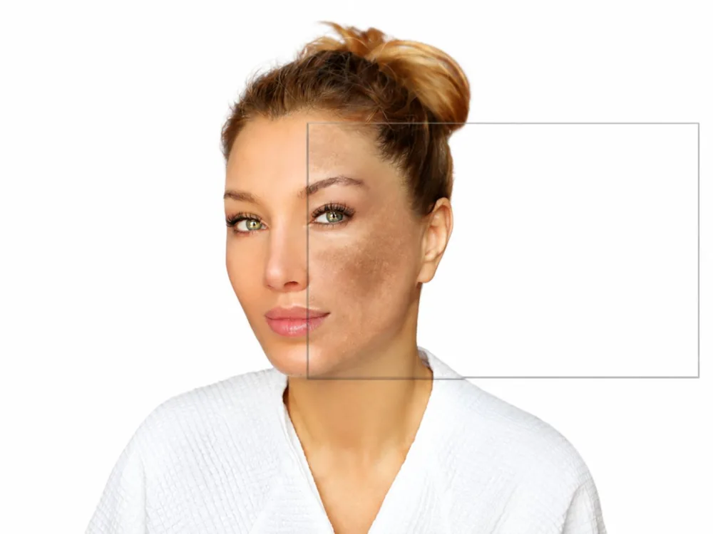 Melasma - Factori Declanșatori și Favorizanți 1 melasma factori declansatori