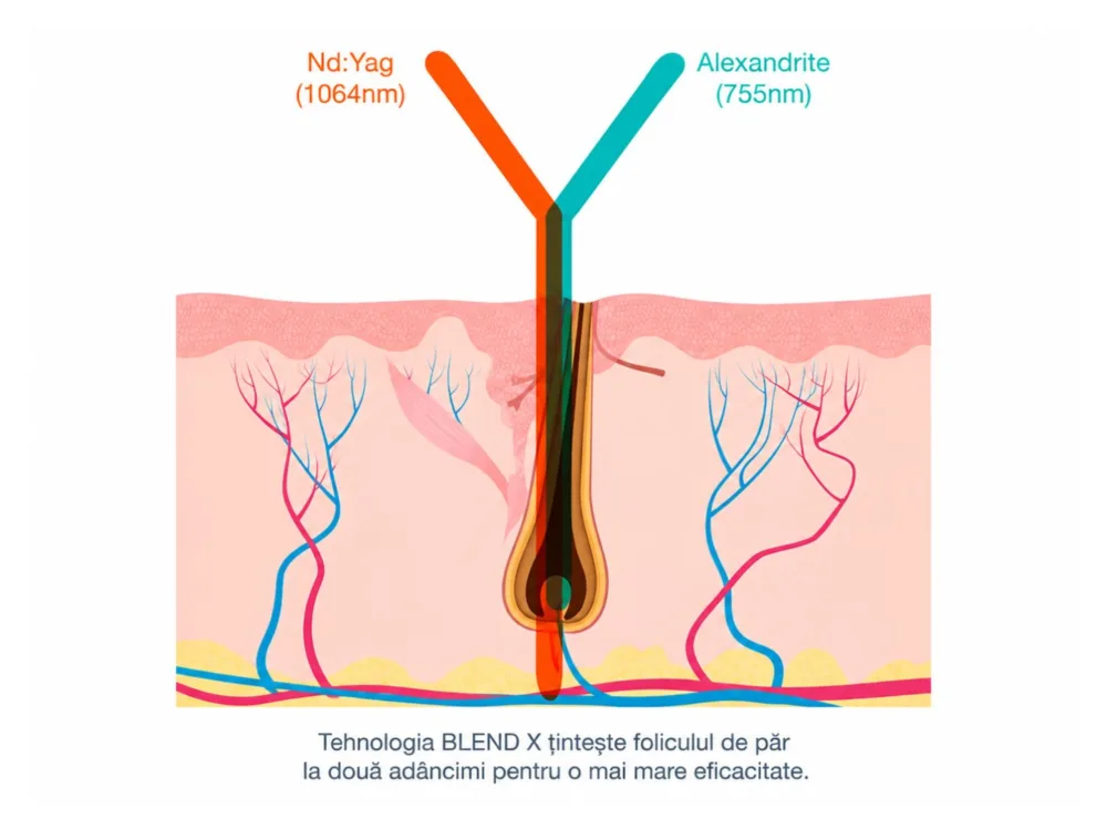 Epilarea cu laser Splendor X – tehnologie, beneficii și rezultate 4 Splendor X