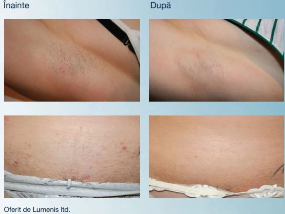 Epilarea cu laser Splendor X – tehnologie, beneficii și rezultate 3 laserul Splendor X