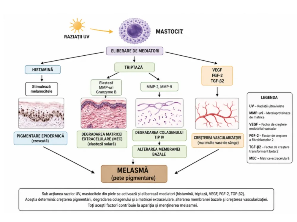melasma