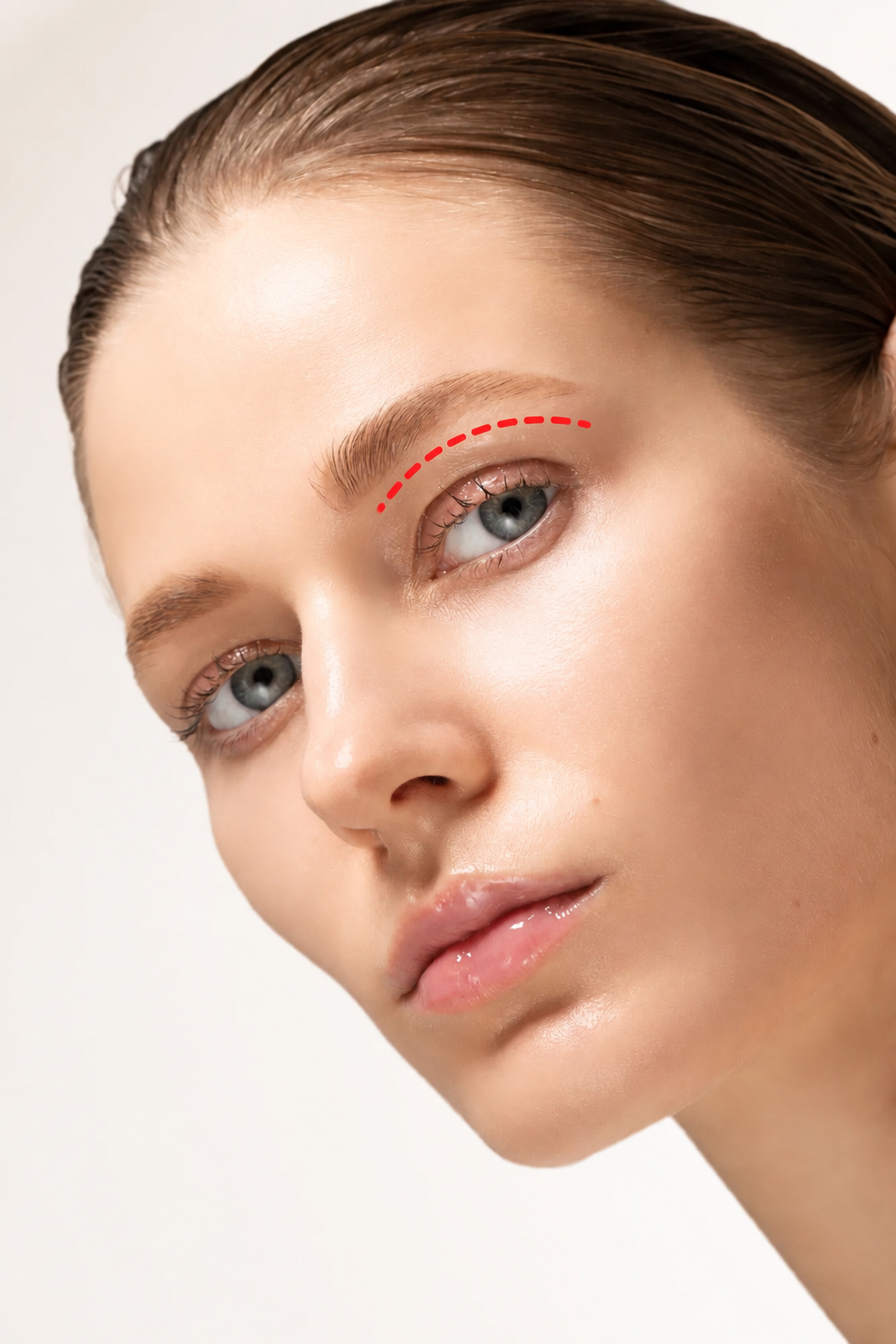 Blefaroplastie superioară