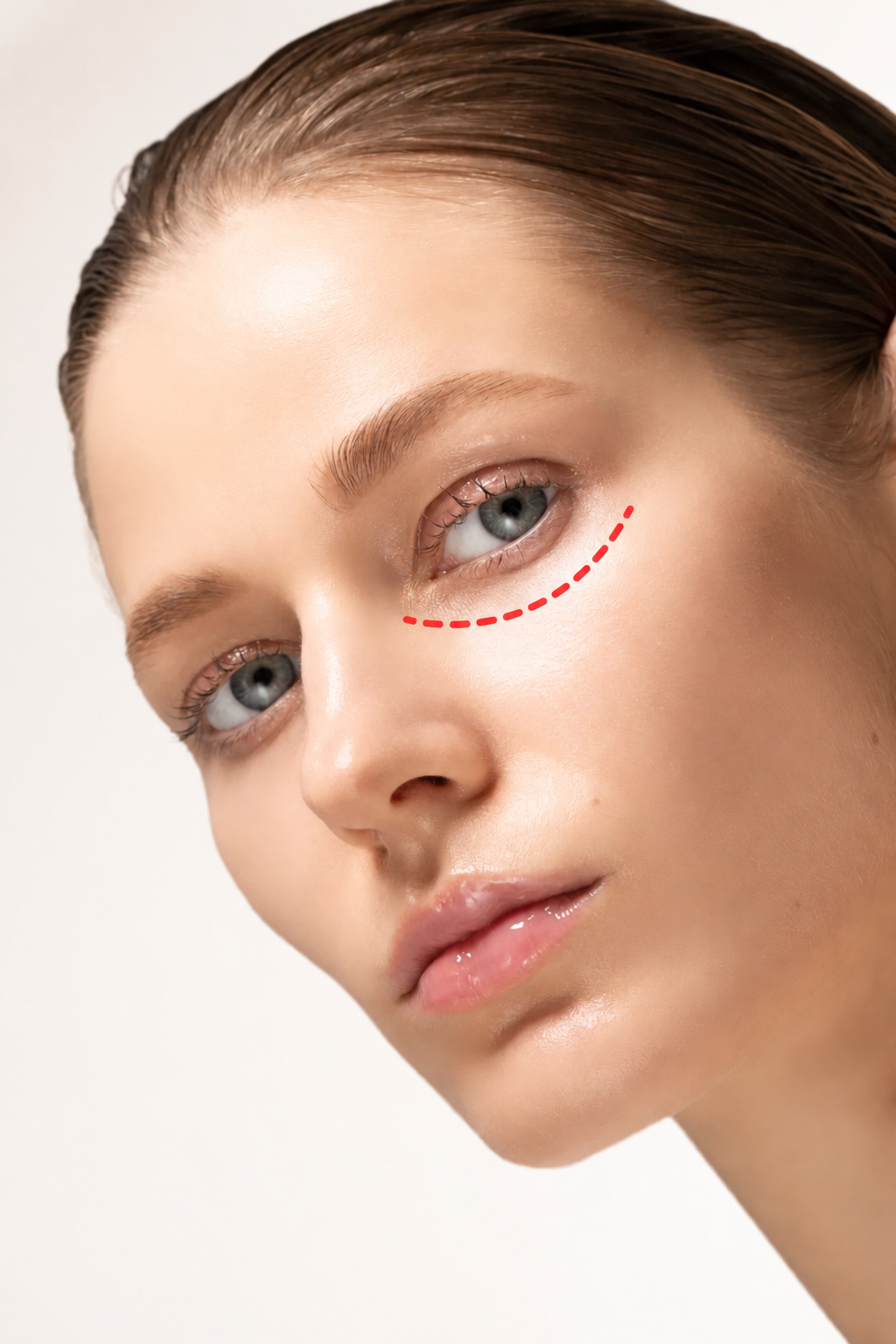 Blefaroplastie inferioara
