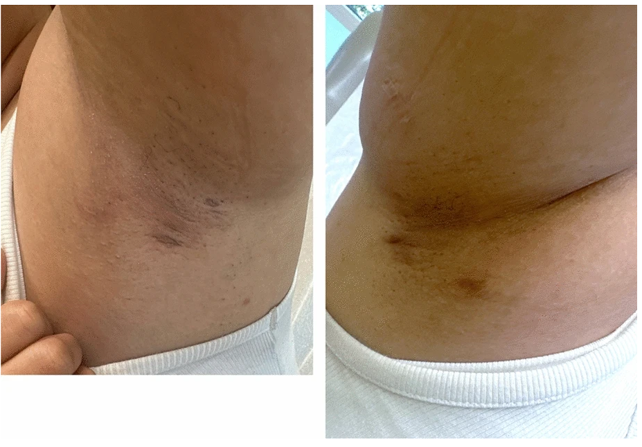 Terapiile GLP-1 și inflamația: implicații în dermatologie și estetică 5 hidradenita supurativa si GLP-1