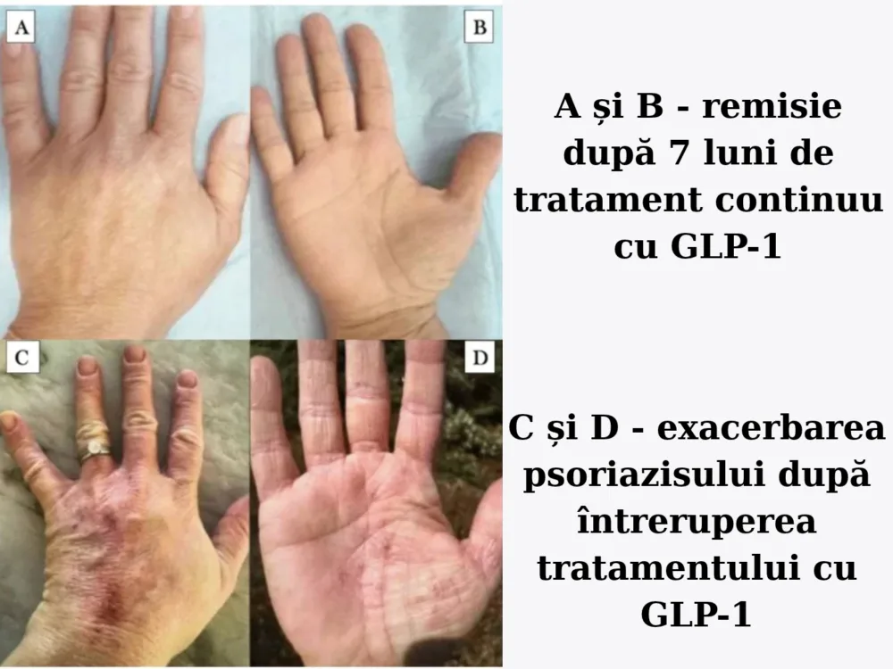 Terapiile GLP-1 și inflamația: implicații în dermatologie și estetică 4 psoriazisul mainilor in remisie după GLP-1